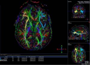 Diffusion Tensor Imaging for Mild Traumatic Brain Injuries